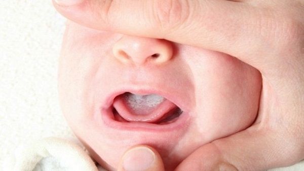Nguyên nhân tưa lưỡi ở trẻ em