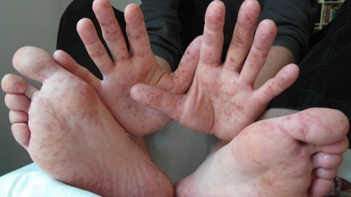 Bệnh chân tay miệng ở trẻ