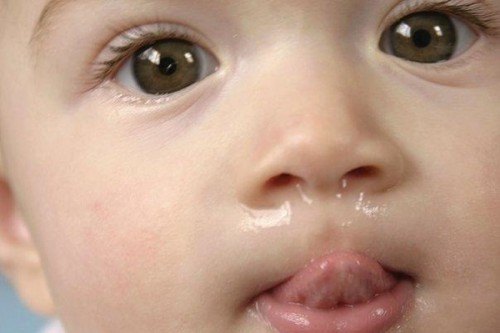 Trẻ sơ sinh bị sổ mũi, nghẹt mũi