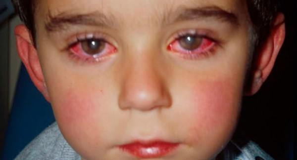bệnh đau mắt đỏ ở trẻ em