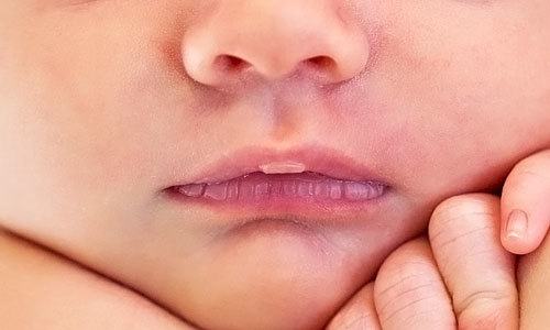 Trẻ sơ sinh bị rộp môi