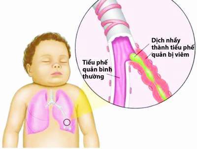 viêm tiểu phế quản ở trẻ gây nghẹt thở