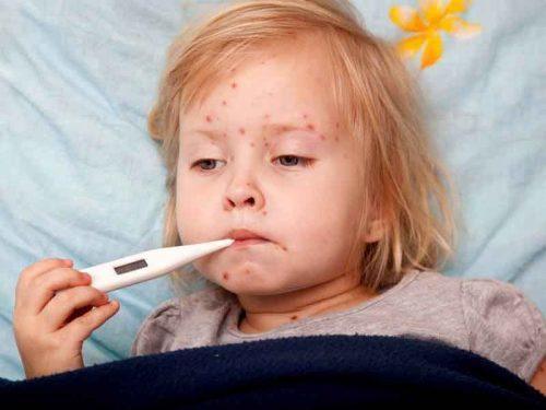 triệu chứng sốt phan ban ở trẻ