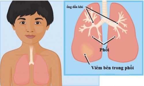 viêm phổi là bệnh nguy hiểm ở trẻ em